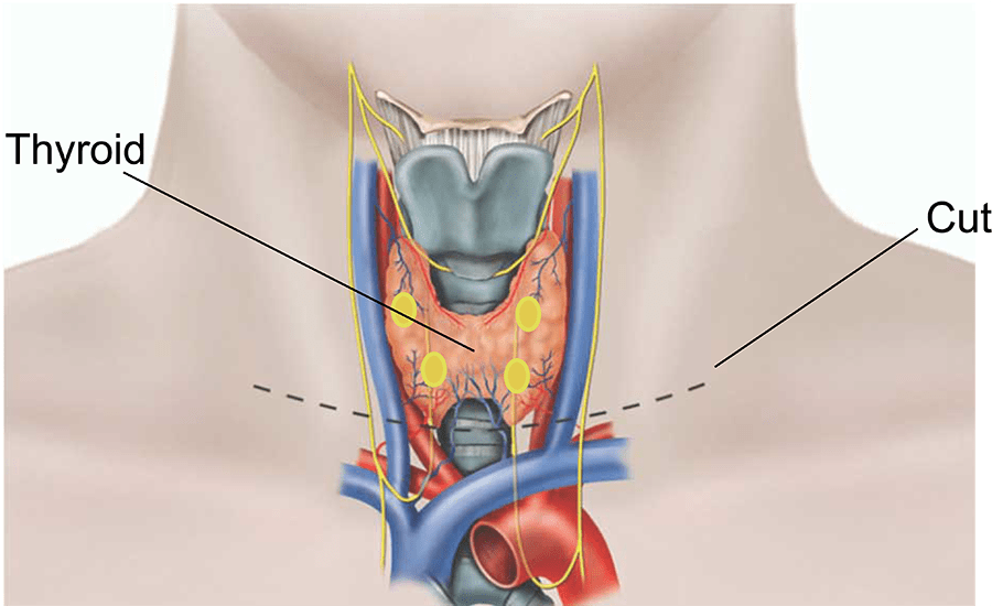 Thyroid Removal Surgery Specialist In Punjab