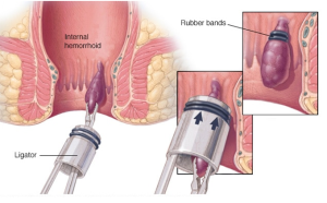 Minimally invasive procedures