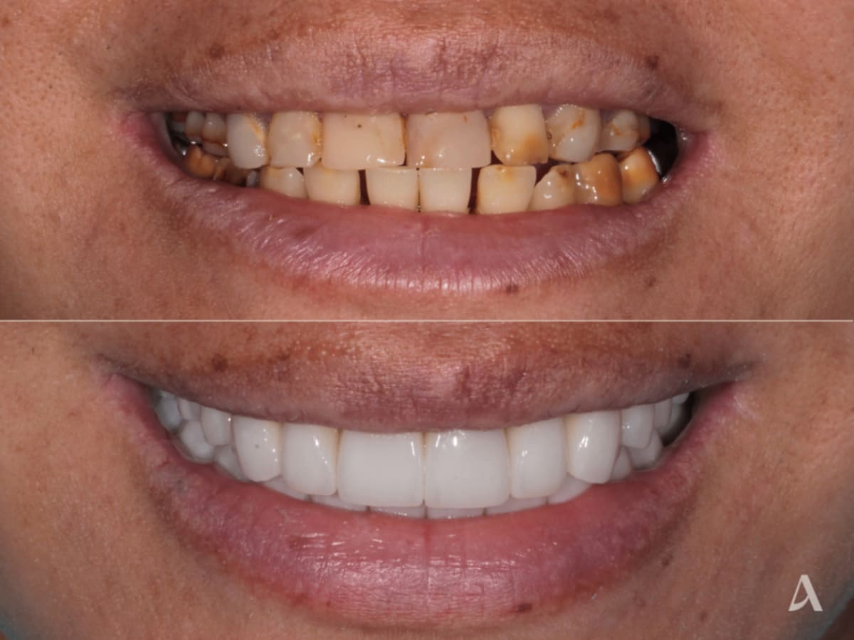 Treatment Ceramic Veneers  Crown & Bridge - Total Procedure Time 1 month