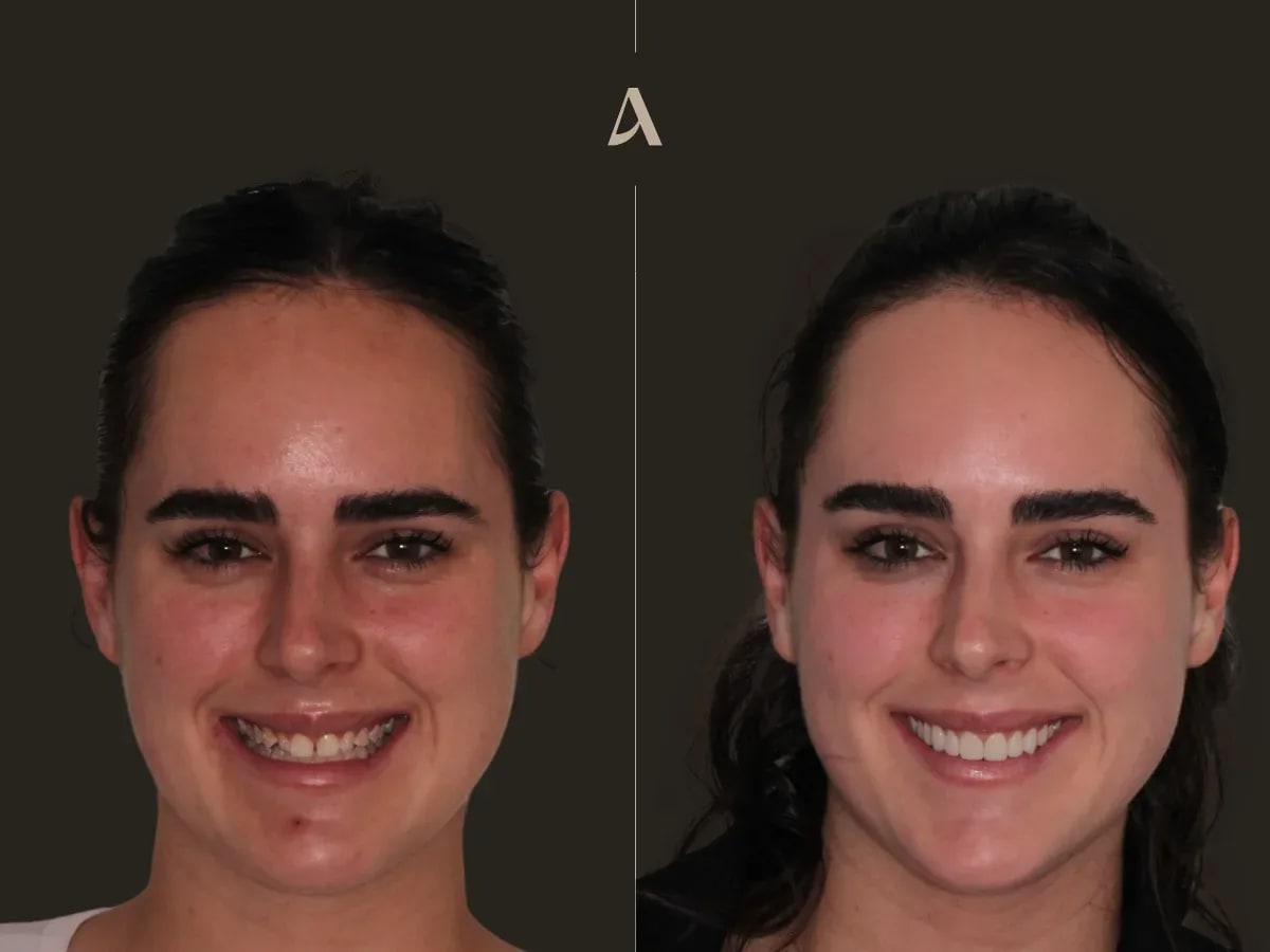 increase-vertical-dimension-zirconia-veneers-1-month