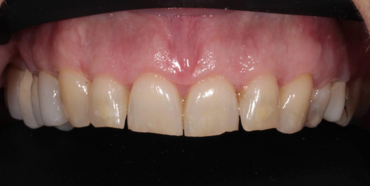 intraoral tori after surgery