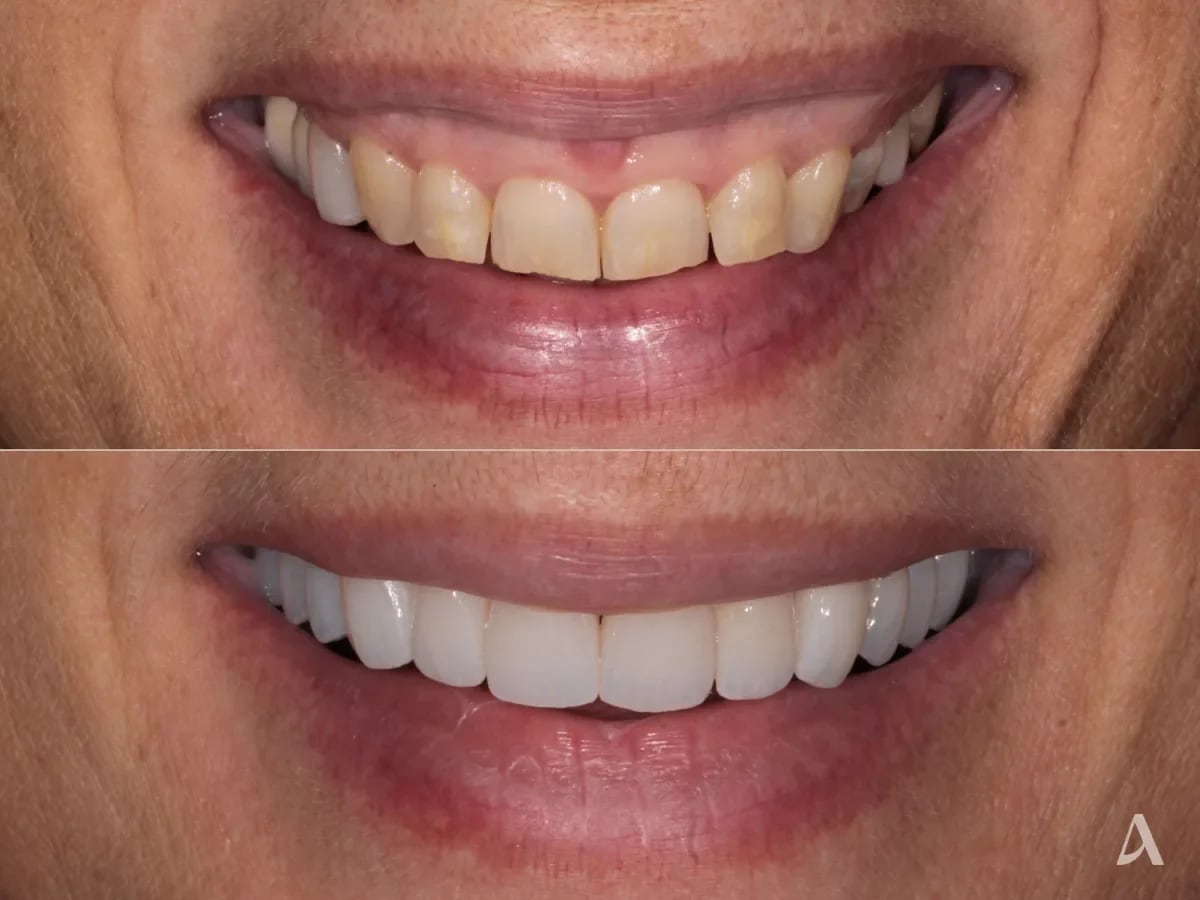 gum-recontouring-zirconia-veneers-3-months