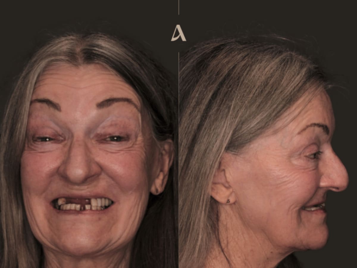 Treatments All on X - Total Procedure Time 2 months