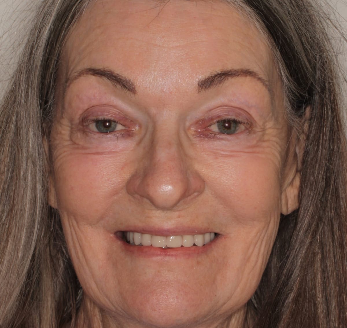 all on x provisional bridge