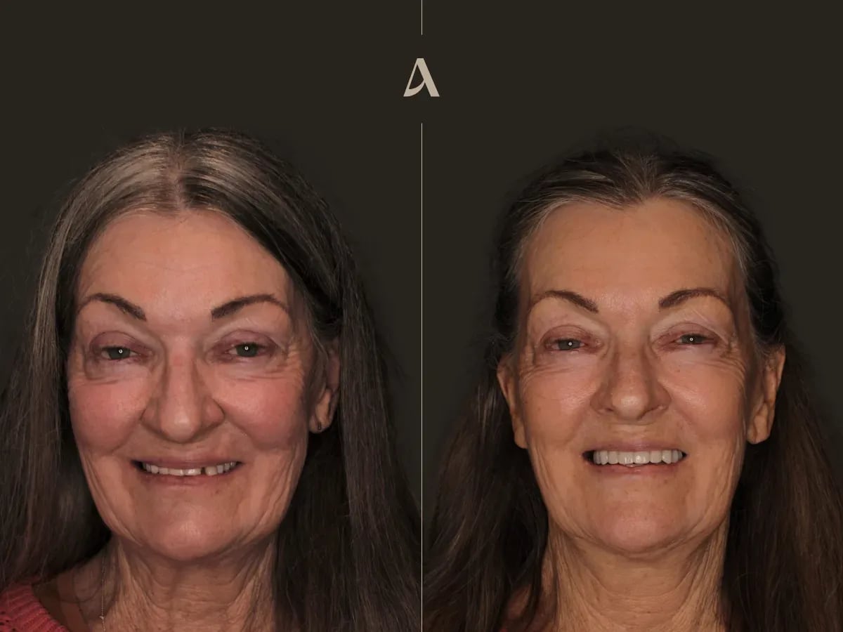 increase-vertical-dimension-all-on-x-3-months