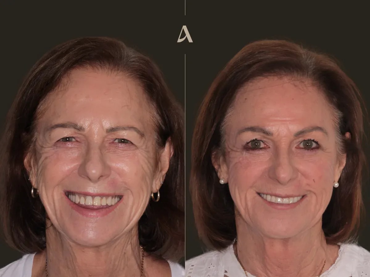 Clinical Case: All on 4 Revision with Zirconia Bridge: When a Smile Finally Feels Right