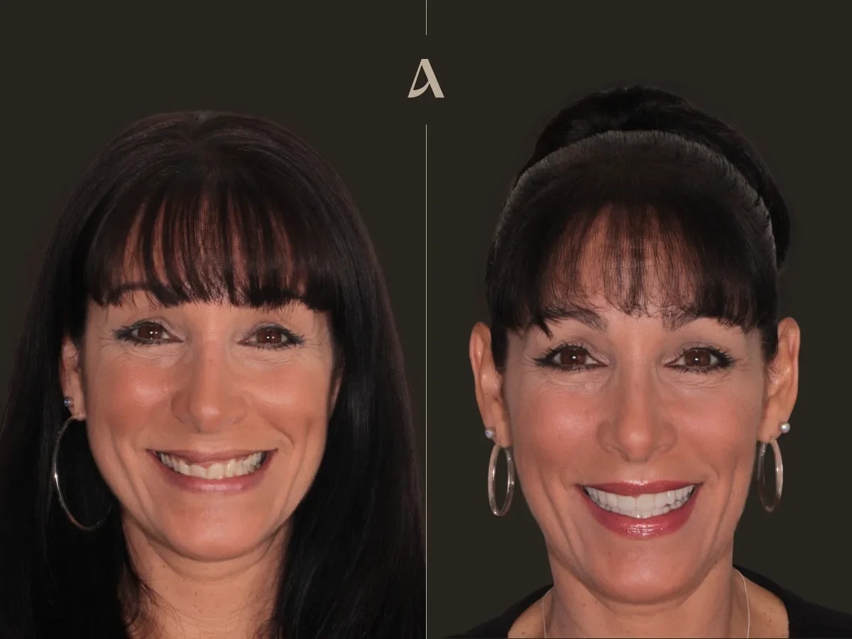 porcelain-veneers-crown-bridge-complex-rehabilitation-increase-vertical-dimension-1-month