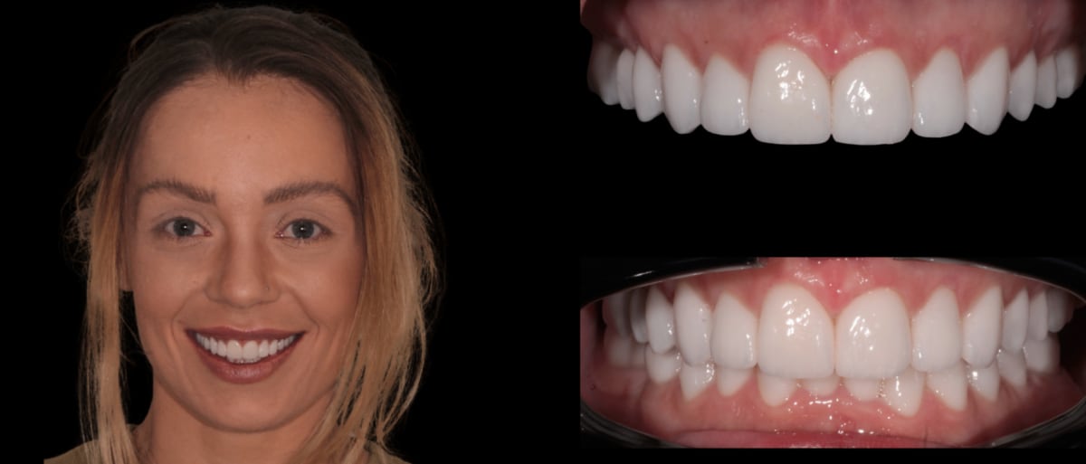 Full mouth rehabilitation after - Artmiles