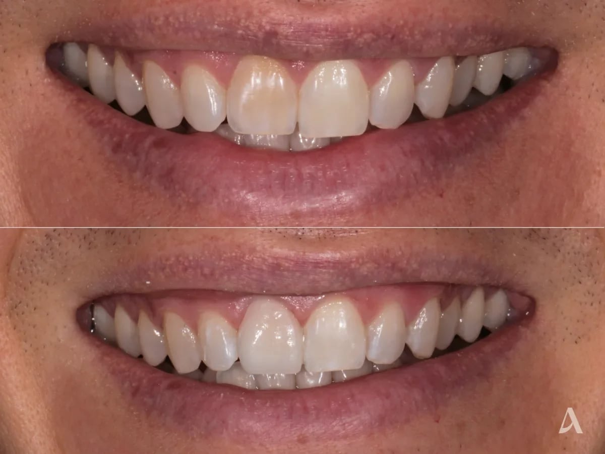 porcelain-veneers-1-month