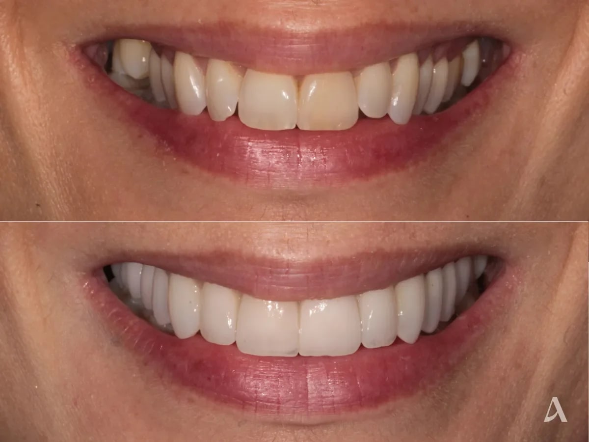 porcelain-veneers-crown-bridge-2-months