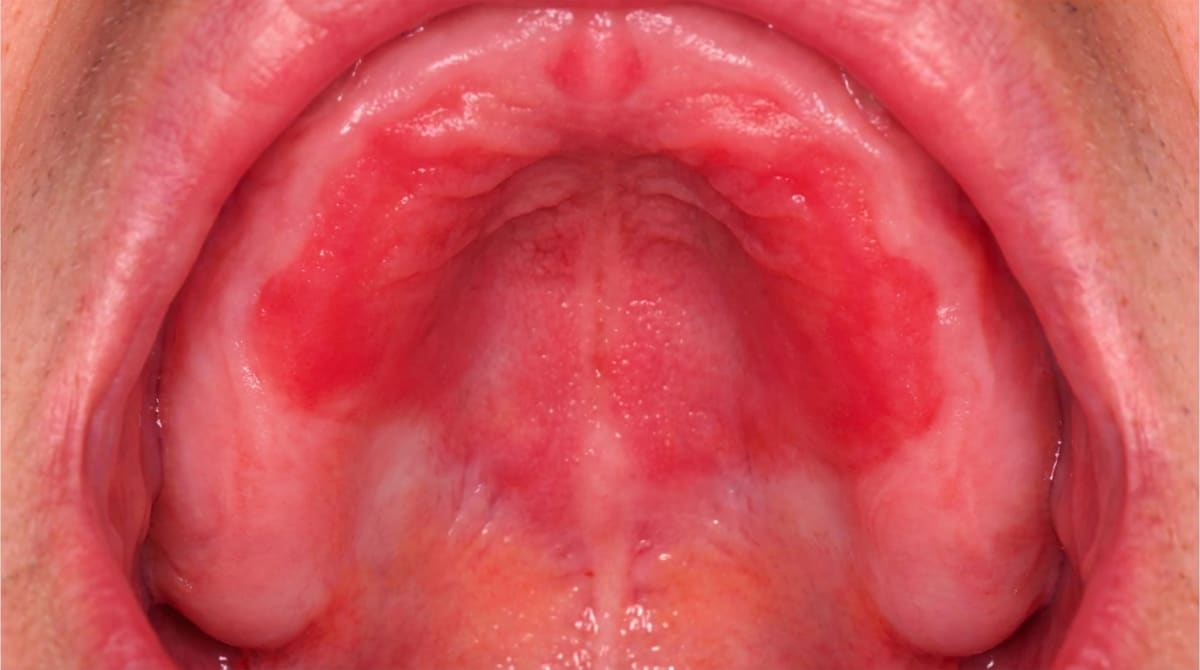 Illustration of the hard palate showing a well-demarcated, bright red area corresponding to the outline of an upper denture, typical of denture stomatitis.