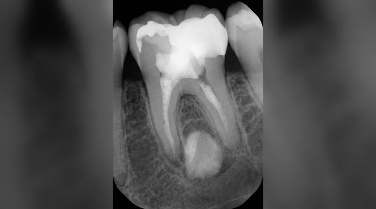 X-ray of a posterior tooth with a large restoration, showing dense white bone at the root tip, consistent with condensing osteitis (focal sclerosing osteomyelitis).