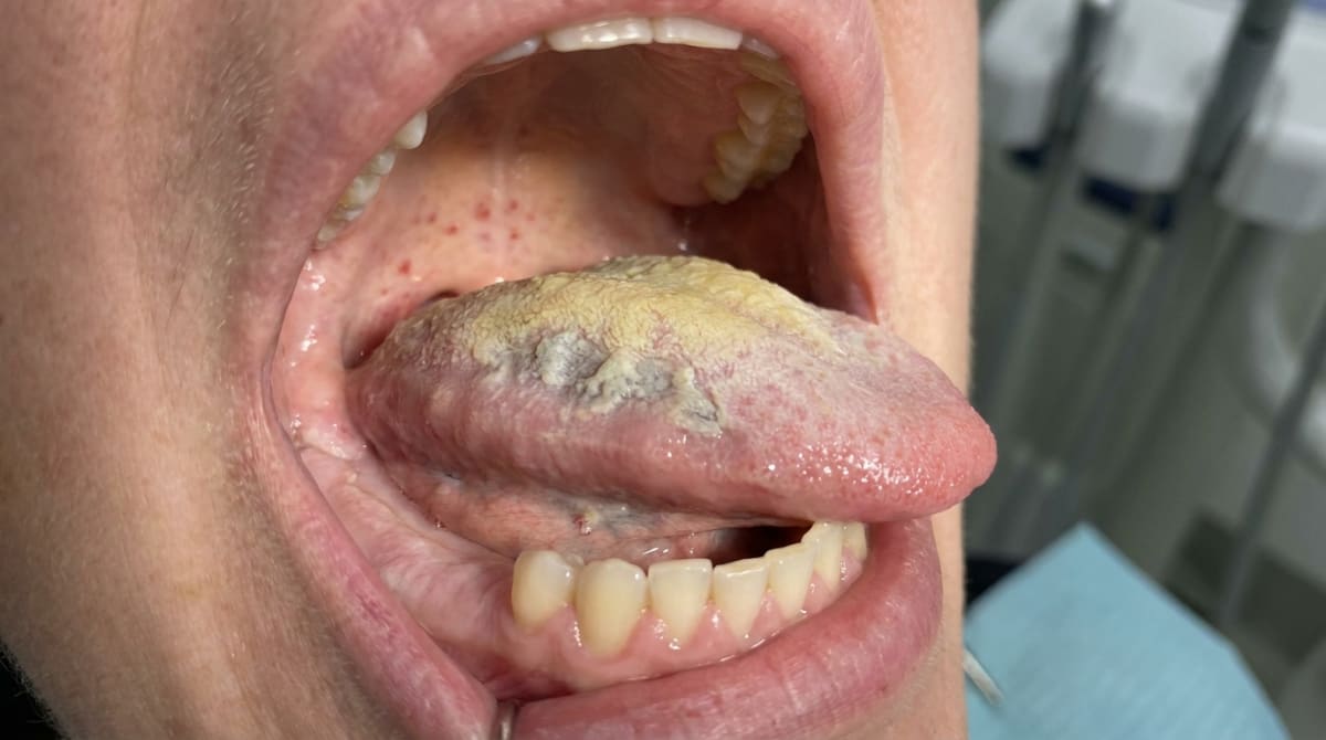 Photograph of the gums in a renal transplant patient on ciclosporin and a calcium channel blocker showing diffuse, firm, pink gingival overgrowth — typical drug-induced gingival hyperplasia.
