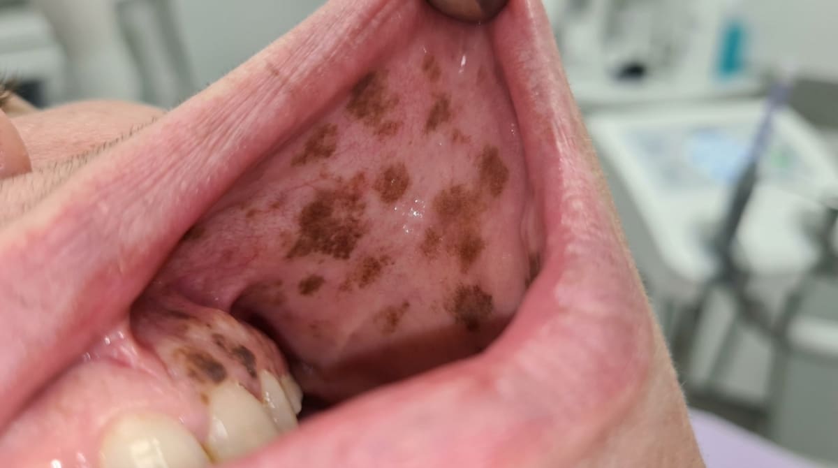 Photograph of the gums and inside of the cheek showing patchy brown to black pigmentation in a patient with Addisons disease — distinguished from physiological pigmentation by recent onset and system…
