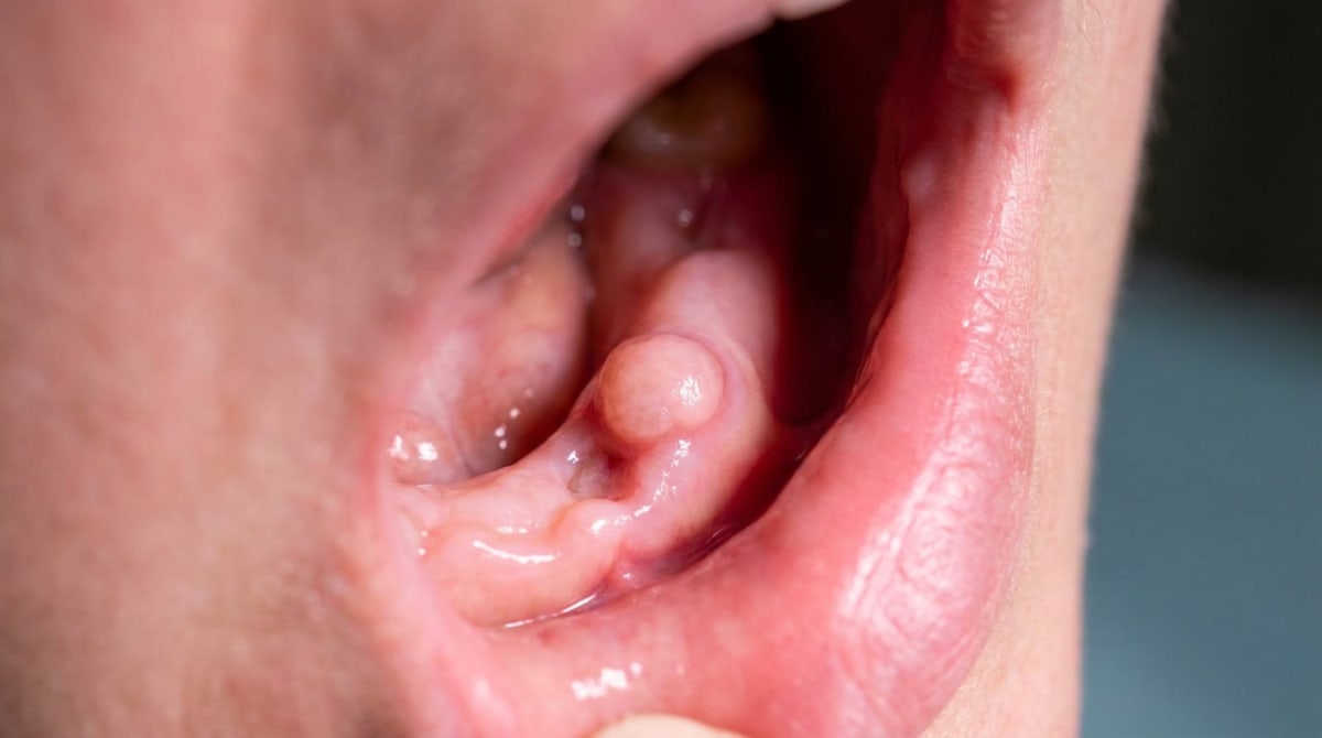 A small, pinkish, well-defined nodule on the mandibular alveolar ridge near the mental foramen, characteristic of a traumatic neuroma.
