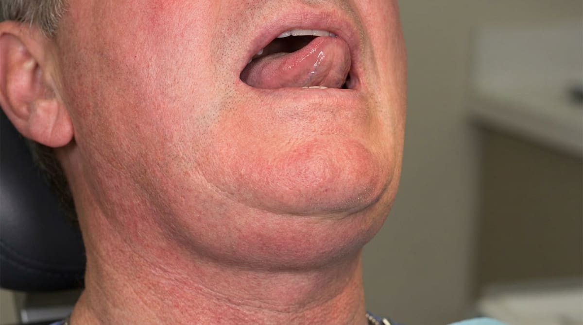 Ludwig's Angina showing bilateral, firm jaw and neck swelling with tense, red skin, and elevated tongue.