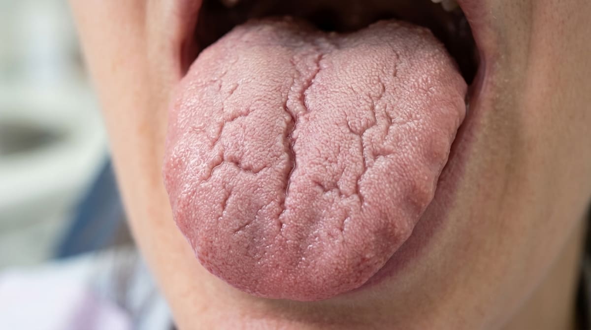 Close-up illustration of a fissured tongue showing multiple grooves and furrows running across the dorsal tongue surface — a benign developmental variation.