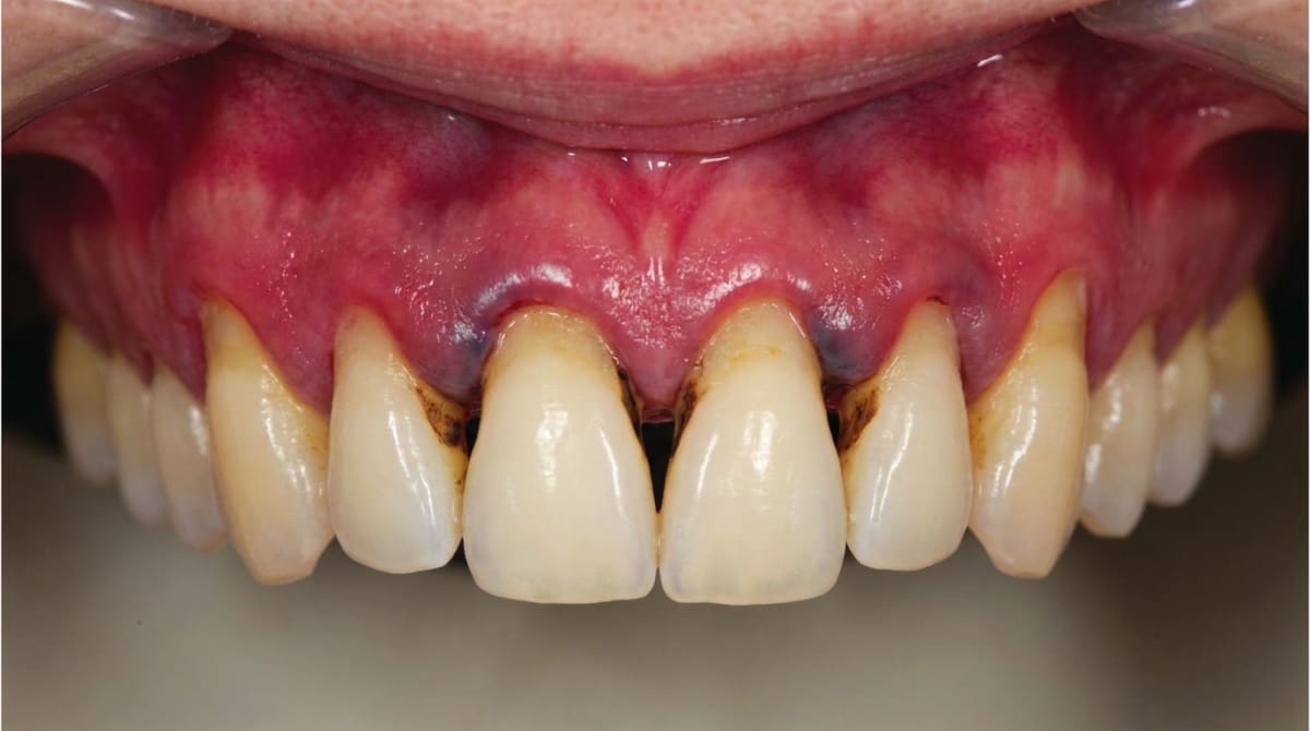 Chronic Periodontitis: Red, swollen, receding gums expose roots, making teeth look longer, with plaque, calculus, and blunted papillae.
