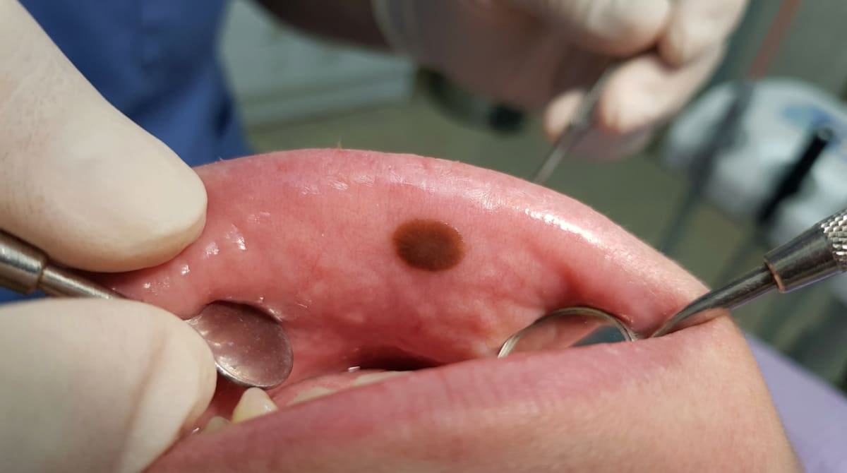 Photograph of the lower lip vermilion showing a small, well-demarcated, uniformly brown macule less than 1 cm across — the typical appearance of an oral melanotic macule.