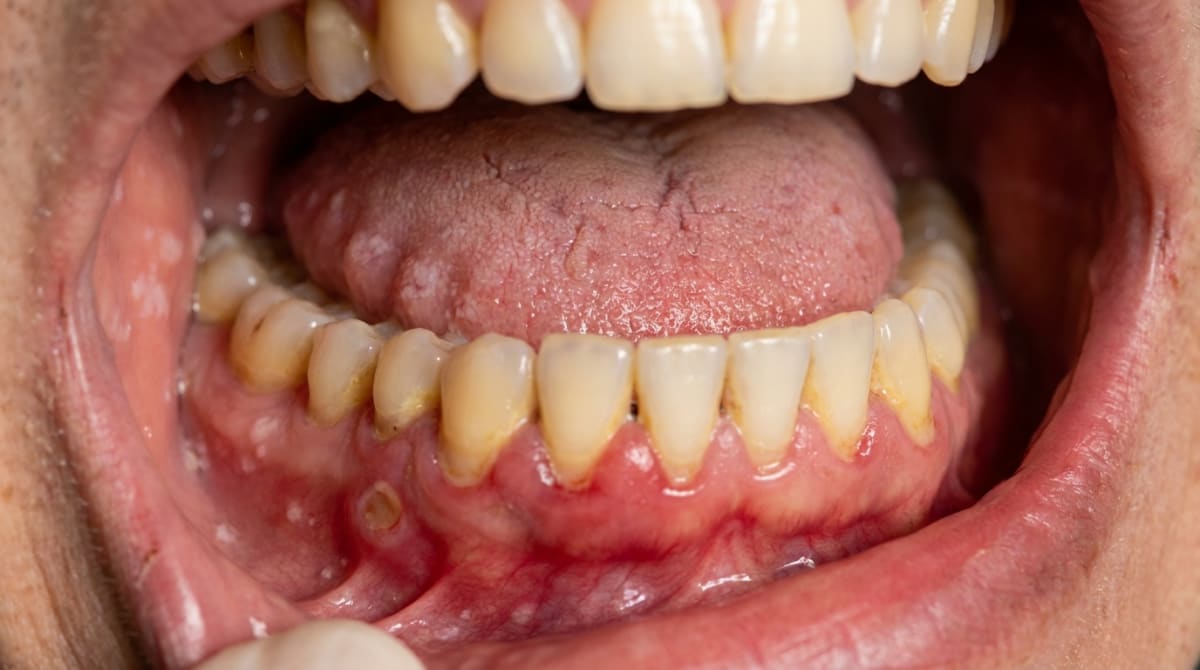Close-up of inflamed gums with dryness and a smooth red patch on the tongue, illustrating oral manifestations of poorly controlled diabetes.