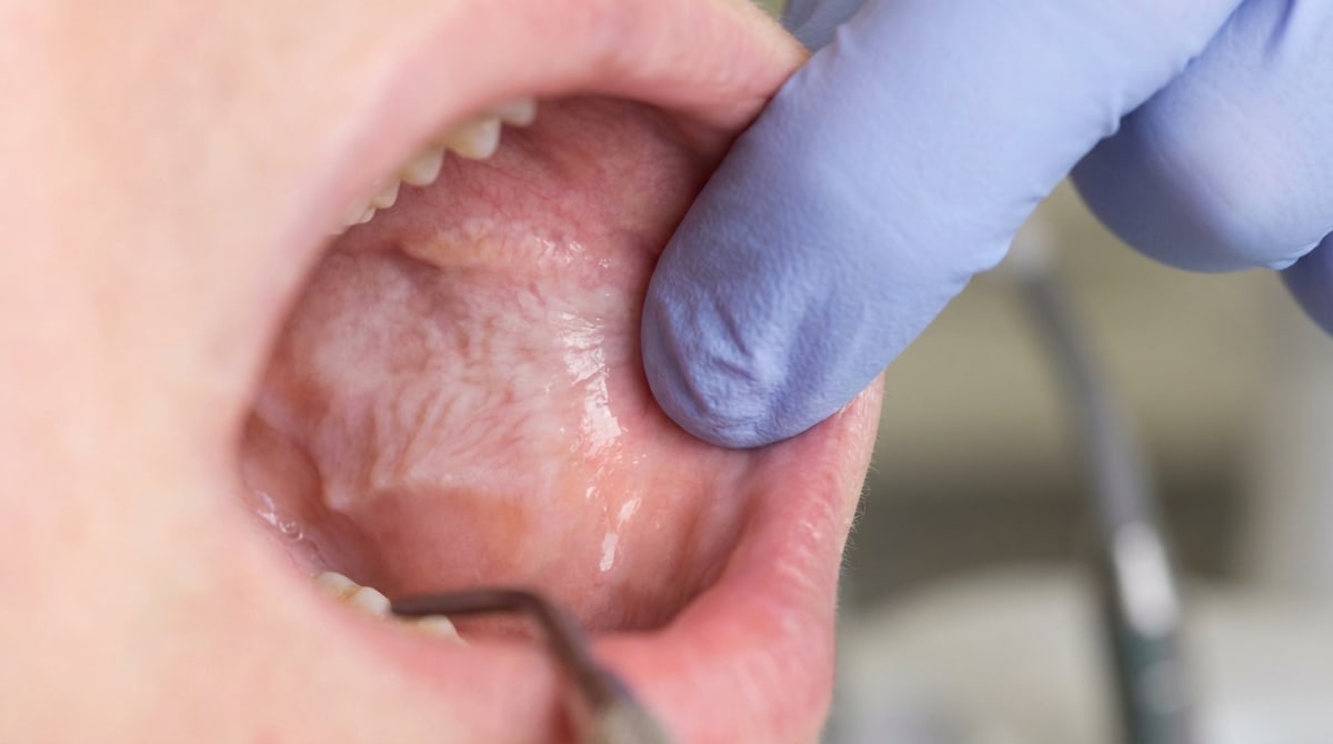 Illustration of the inside of both cheeks showing a diffuse, faint, milky-white appearance with subtle wrinkles, typical of leukoedema.