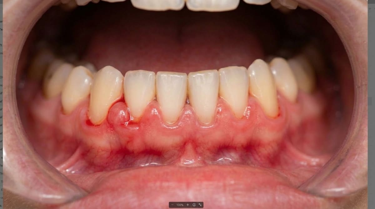 Close-up of swollen, reddened gums between the upper front teeth in a pregnant woman, illustrating pregnancy gingivitis.