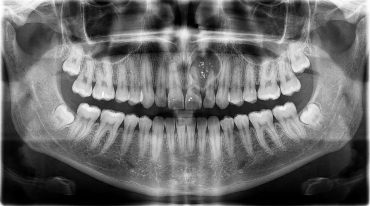 Cropped panoramic X-ray showing a well-defined mixed radiolucent and radiopaque lesion in the anterior maxilla — typical appearance of a calcifying odontogenic cyst.