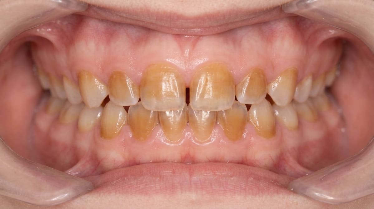 Clinical photo of anterior primary teeth with brown discolouration and translucency, typical of Dentin Dysplasia Type II.