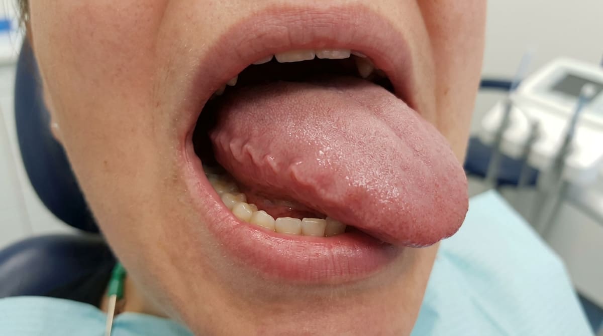 Clinical photograph illustrating typical features of Macroglossia.