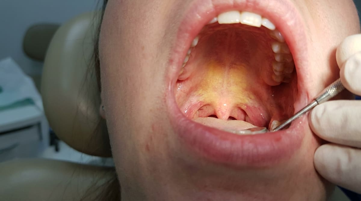 Clinical photo of a yellow soft palate and uvula, an oral manifestation of liver disease.