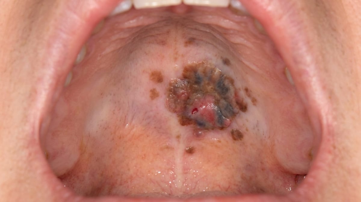 Photograph of the hard palate showing a flat, irregularly shaped dark brown to black macule with uneven borders and an early raised area — characteristic of oral mucosal melanoma.
