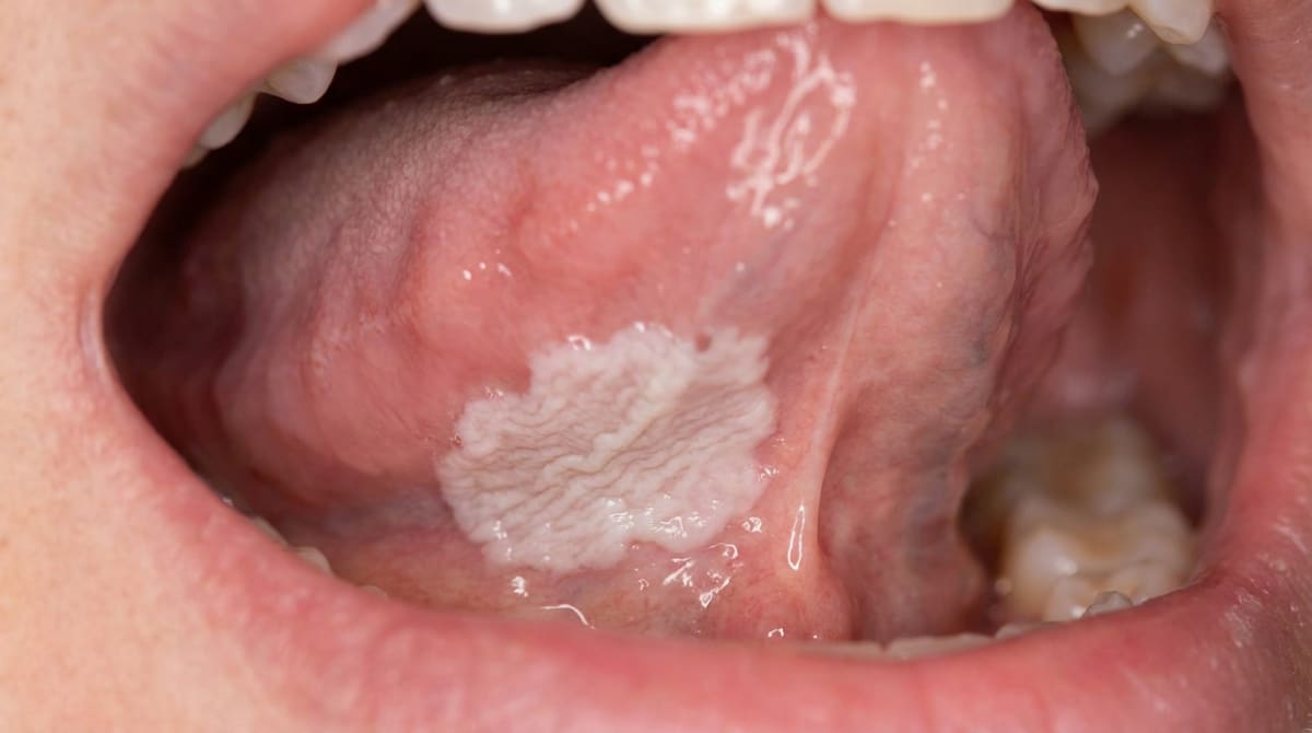 Illustration of the floor of the mouth showing a flat white plaque with a finely corrugated, ebbing-tide surface, typical of sublingual keratosis.
