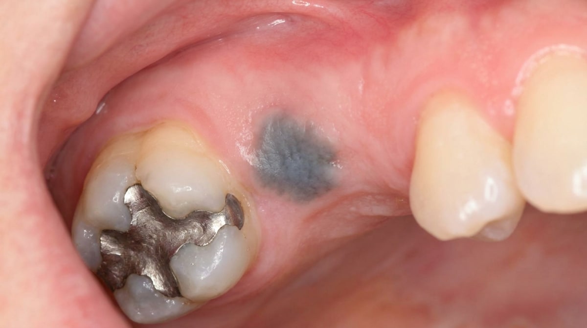 Photograph of the lower gum showing a flat, well-defined grey-blue stain adjacent to old amalgam-restored teeth — typical of an amalgam tattoo.