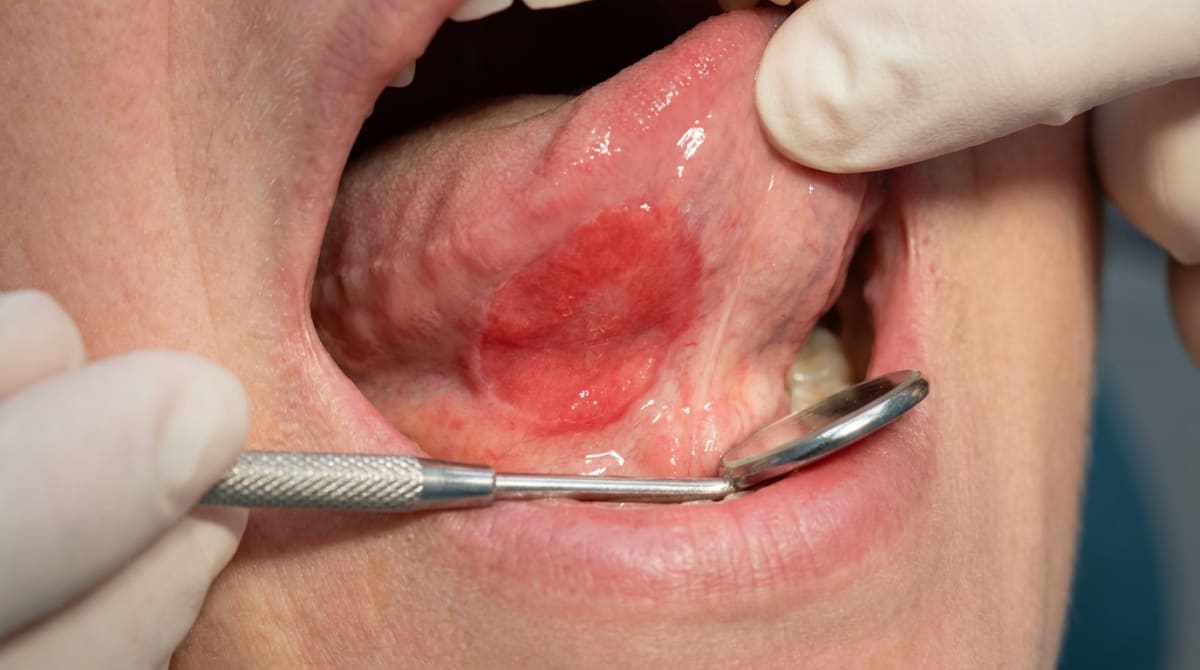 Illustration of the floor of the mouth showing a well-demarcated velvety red patch with a smooth surface, the typical appearance of oral erythroplakia.