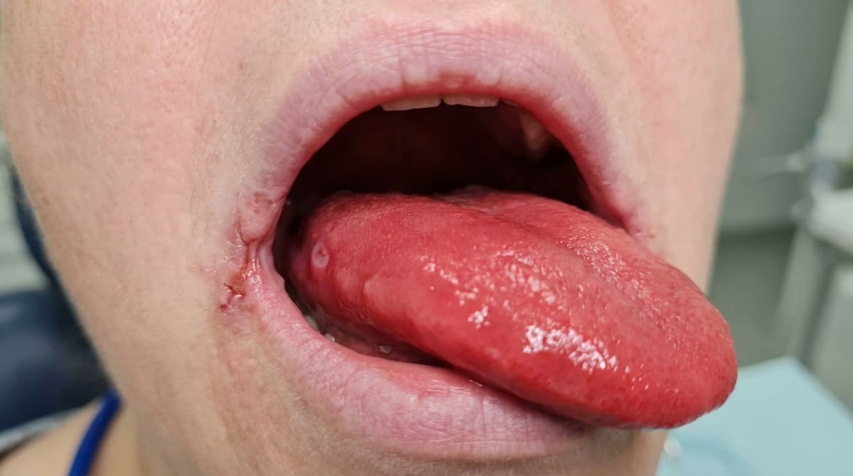 Smooth, red tongue and angular cheilitis — common oral signs of iron or B12 deficiency anaemia
