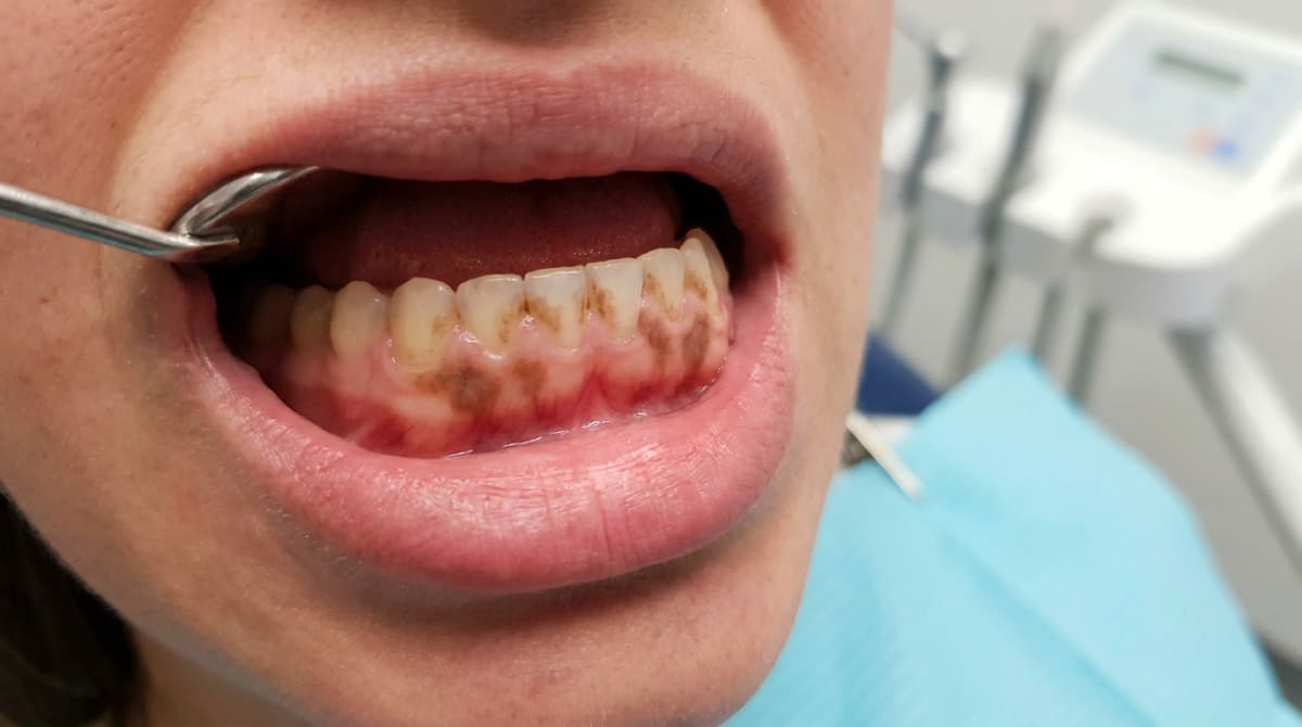 Clinical photo shows smoker's melanosis: irregular brown patches on healthy anterior gum.