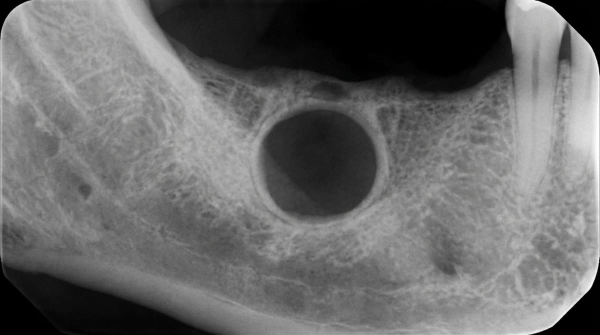 Panoramic dental radiograph showing a well-defined rounded radiolucency in an edentulous area of the mandible — typical of a residual cyst at the site of a previous extraction.