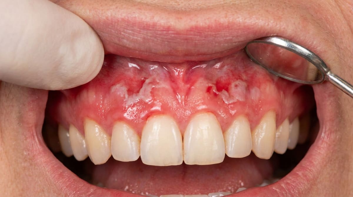 Illustration of widespread bright red, smooth, shiny gums with patches of peeling surface lining, typical of desquamative gingivitis.