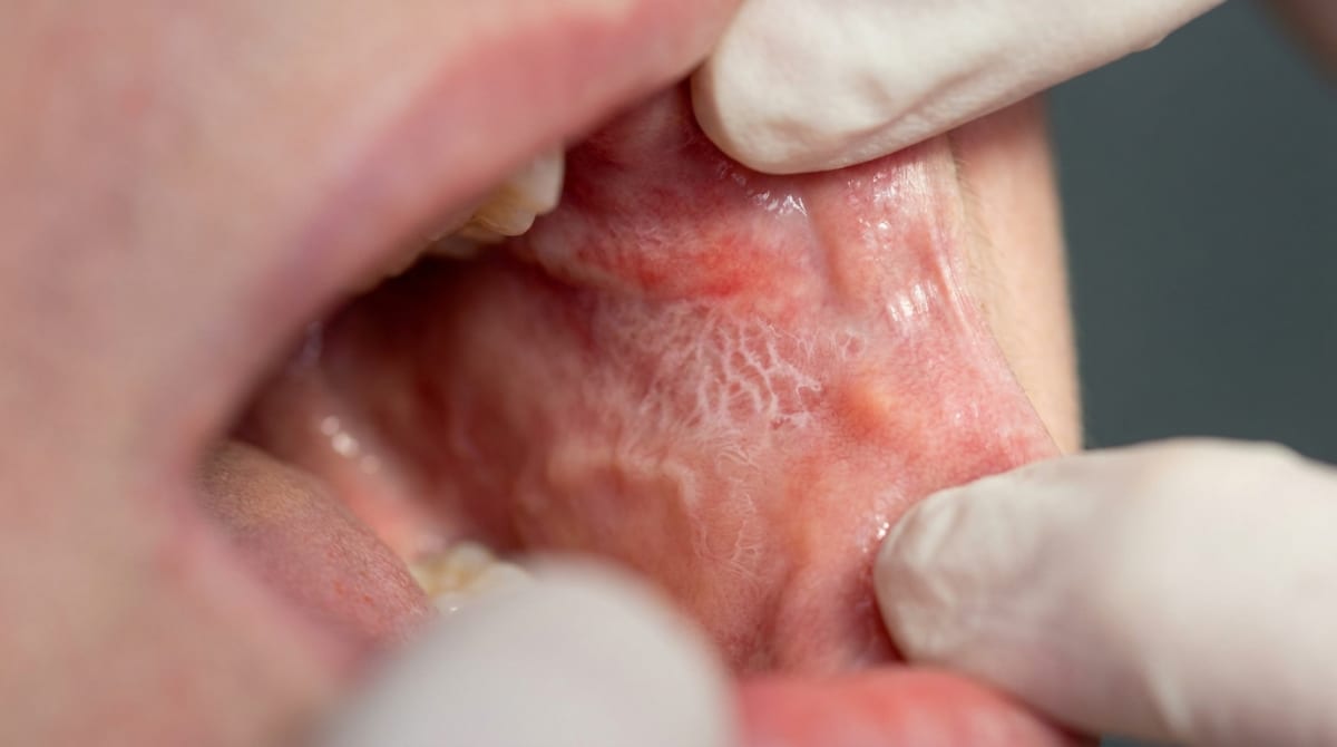Close-up of buccal mucosa with lacy white striae and red patches, characteristic of a lichenoid drug reaction.