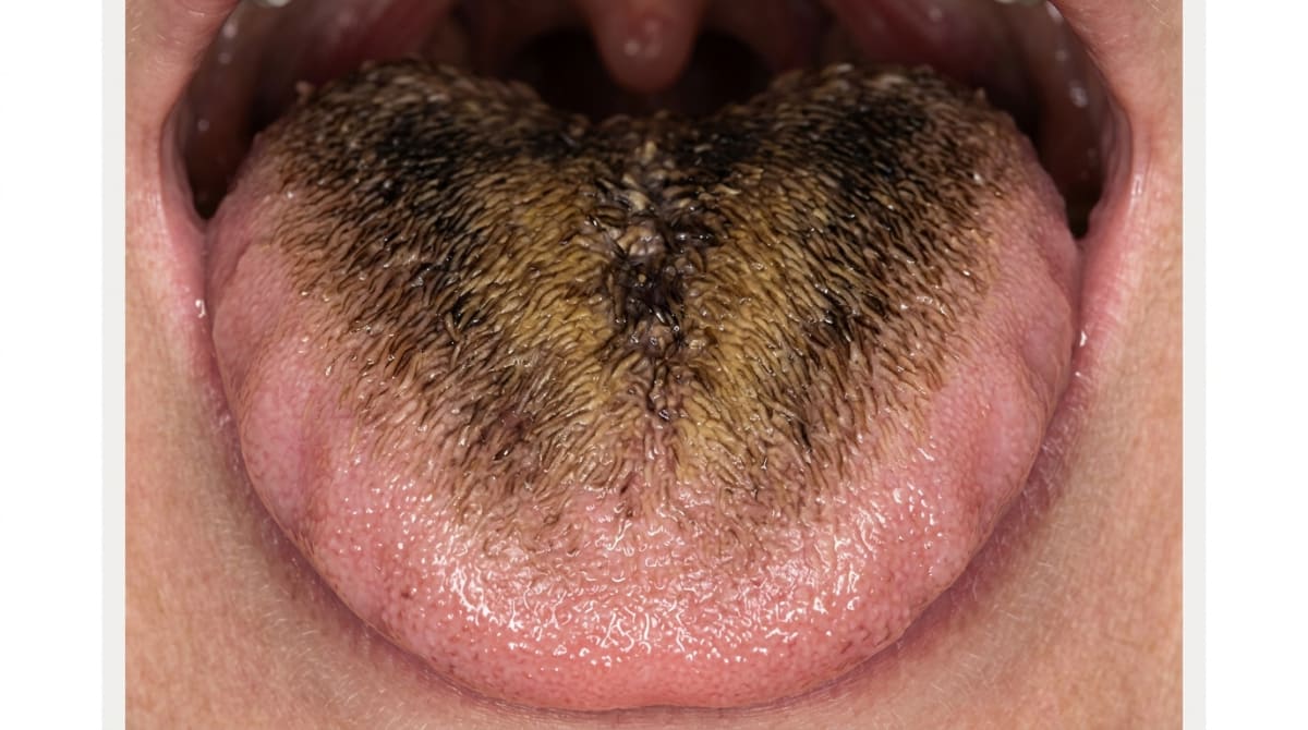 Close-up of a black hairy tongue showing elongated, dark filiform papillae on the central dorsum, sparing the lateral and anterior borders.