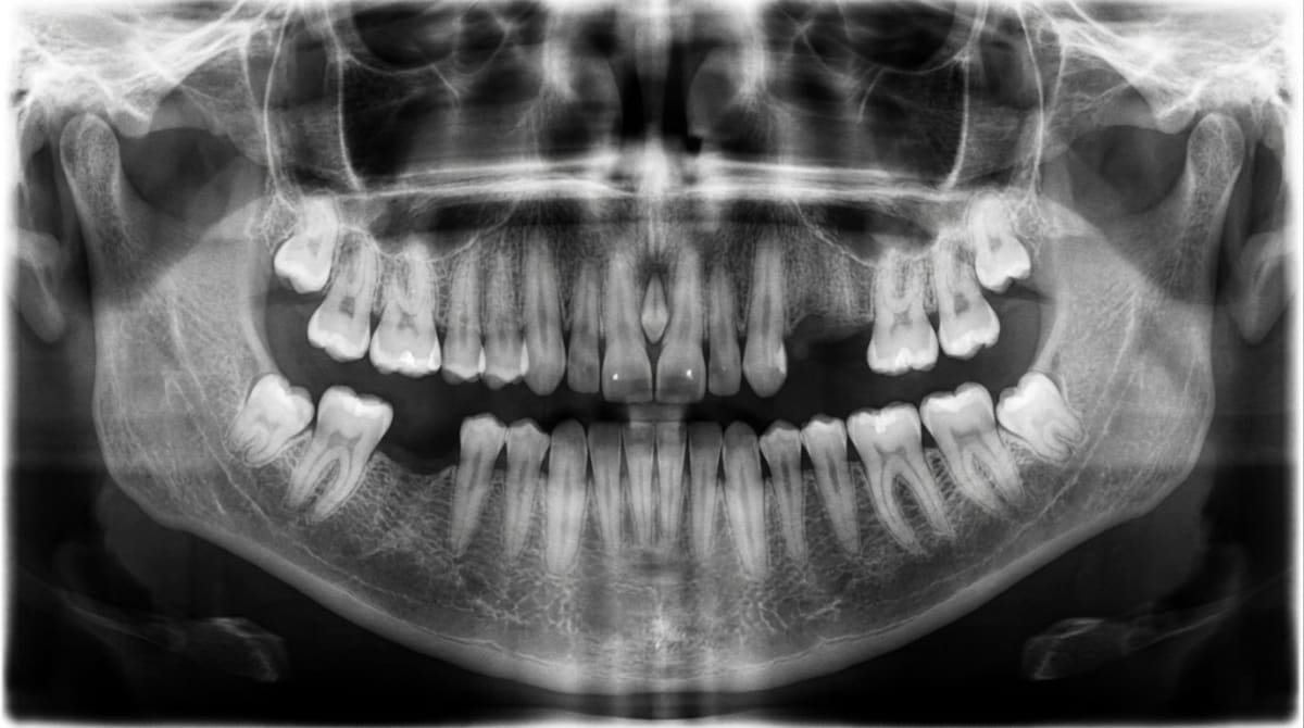 Dental panoramic X-ray showing both missing teeth and a small mesiodens supernumerary tooth between the upper central incisors — illustrating both hypodontia and hyperdontia.