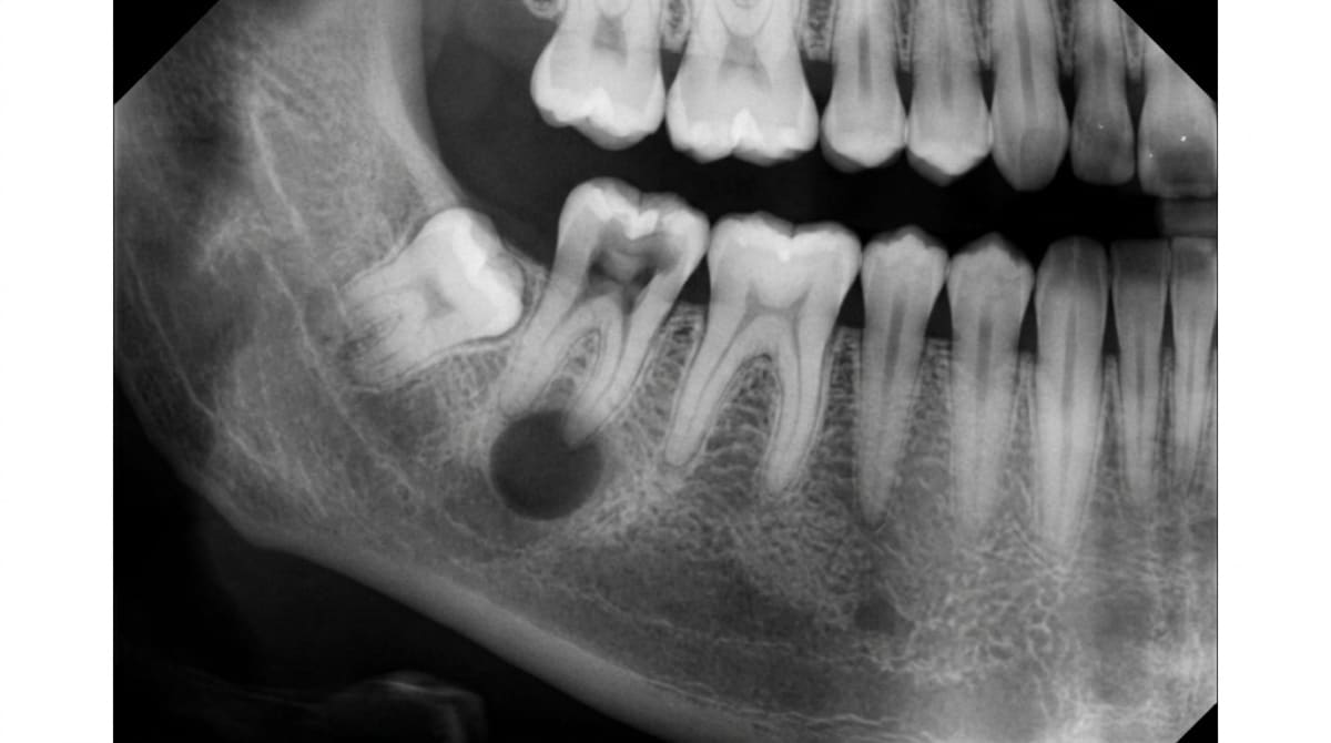 Dental periapical X-ray showing a small, well-defined dark area at the tip of a tooth root, characteristic of a periapical granuloma.