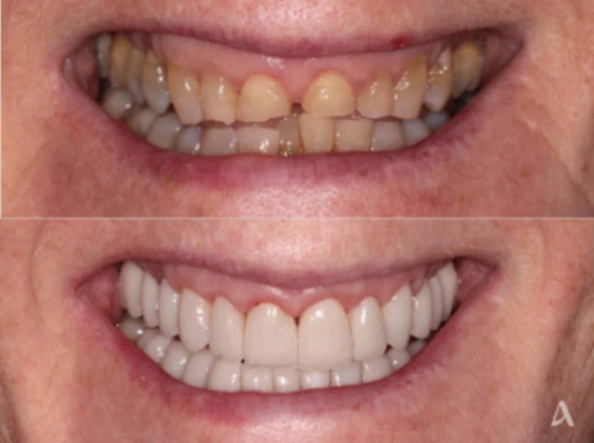 porcelain-veneers-crown-bridge-complex-rehabilitation-increase-vertical-dimension-3-months