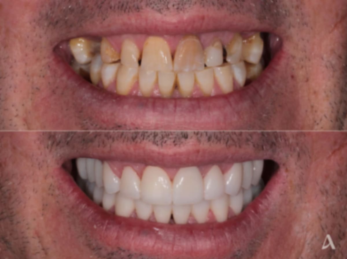 complex-rehabilitation-crown-bridge-zirconia-veneers-increase-vertical-dimension-1-month