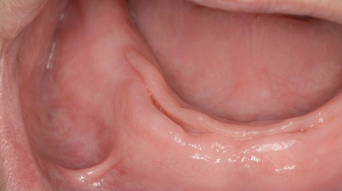 Epulis fissuratum: a prominent folded ridge of fibrous tissue in the oral vestibule, from chronic denture irritation.