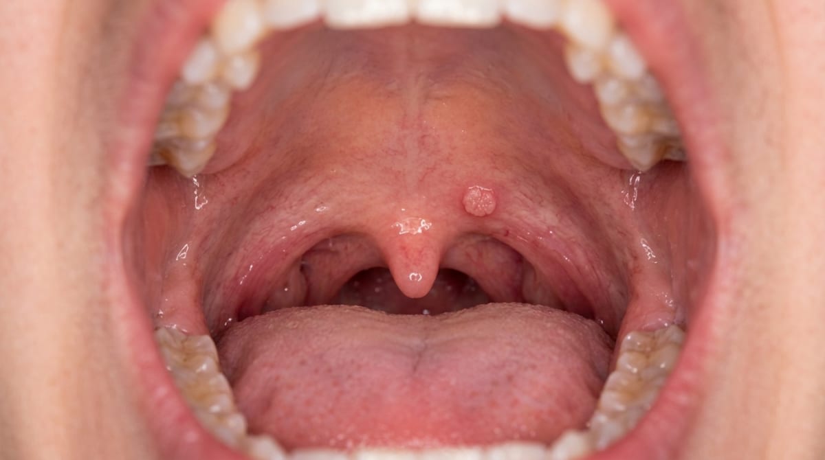 Photograph of the soft palate showing a small pedunculated cauliflower-like white papilloma — a benign HPV-related oral squamous papilloma.