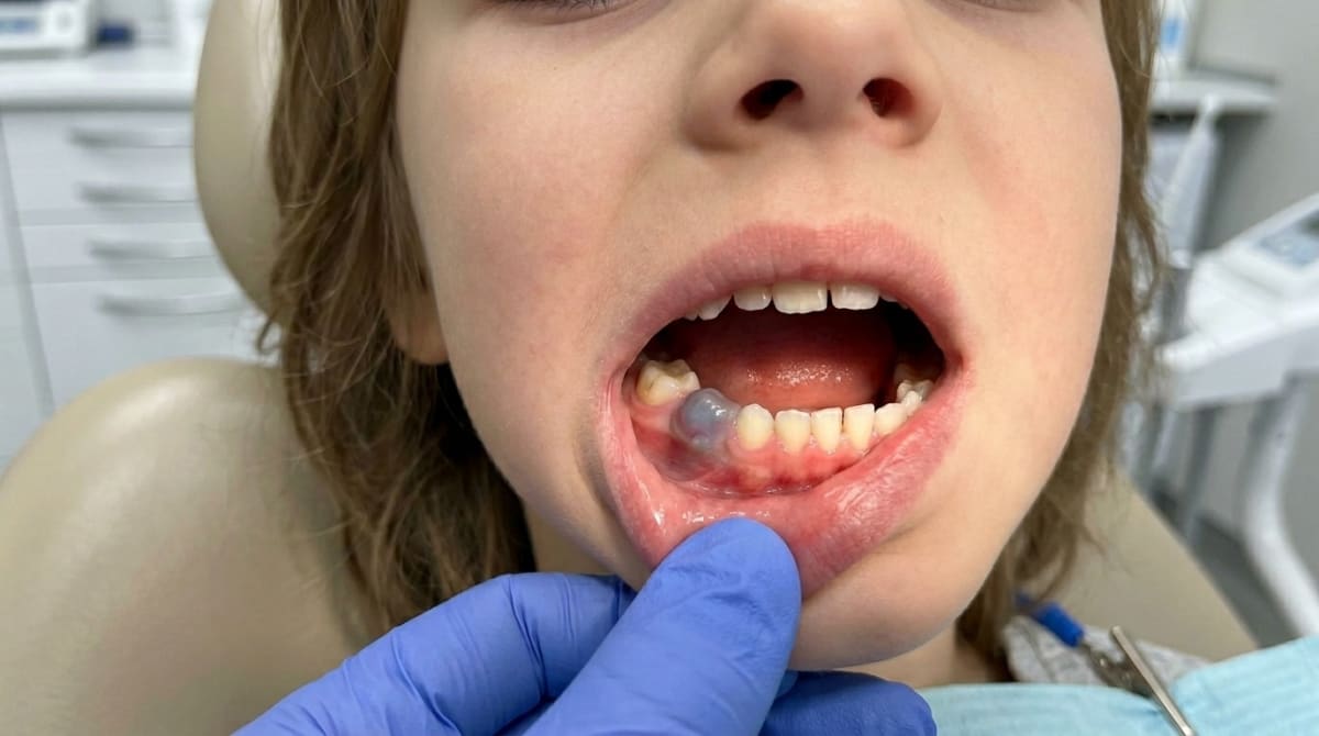Photograph of a child's lower gum showing a soft, bluish dome-shaped eruption cyst over an erupting first molar — the cyst contains old blood from minor biting trauma.