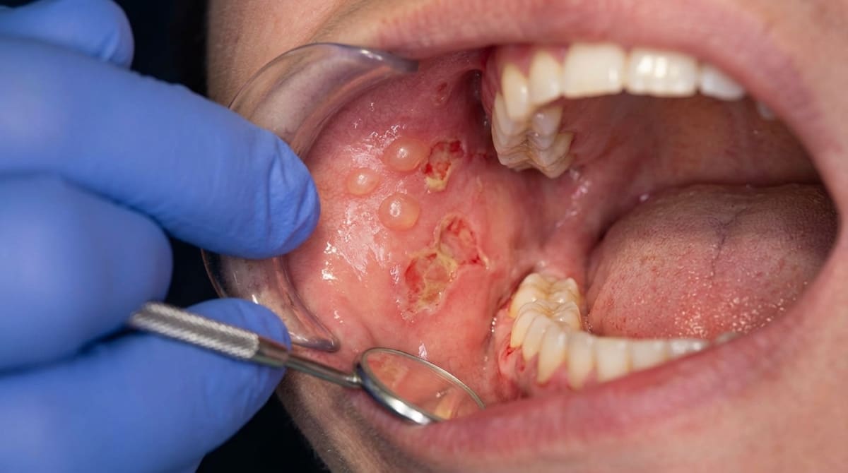 Small intact blisters and erosions on the inside of the cheek, shown during an oral exam, illustrating the kind of oral involvement that can occur in bullous pemphigoid