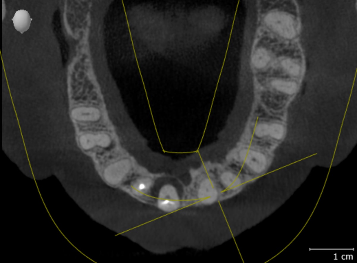 PL_VO1_SICAT_Implant-Panorama-Axial_20260603_164932_2025-05-14_14_44