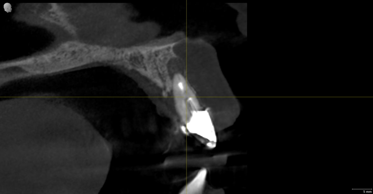 PL_VO1_SICAT_Implant-Panorama-Cross-Sectional_20260603_165039_2025-05-14_14_44